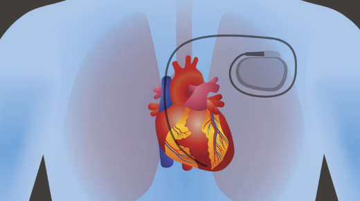 Understanding Pacemaker Failure to Sense - ECG Strip Analysis