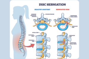 Slipped Disc, Slipped Disc Treatment