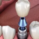 Annapolis dental implants