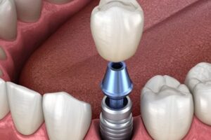 Annapolis dental implants