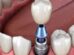 Annapolis dental implants