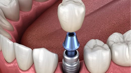 Annapolis dental implants