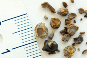 kidney stone treatment