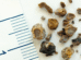 kidney stone treatment
