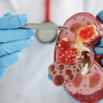 Best Nephrologist in bangalore