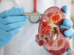 Best Nephrologist in bangalore