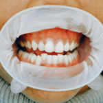 mouth cancer treatment in india