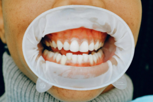 mouth cancer treatment in india