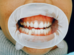mouth cancer treatment in india